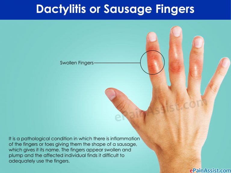 Dactylitis or Sausage Fingers – Causes, Types, Symptoms, Treatment