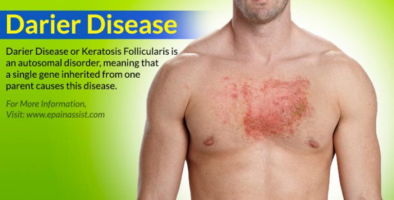 Darier Disease or Keratosis Follicularis: Causes, Signs, Symptoms, Investigations, Treatment
