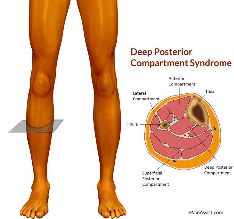 Deep Posterior Compartment Syndrome: Symptoms, Causes, Treatment