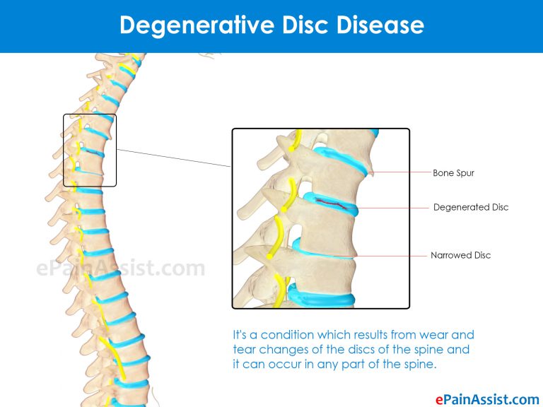 Types of Degenerative Disc Disease & Its Symptoms, Treatment, Pathophysiology
