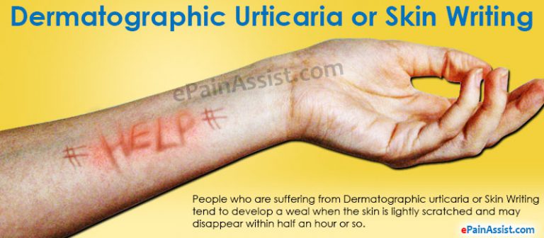 Dermatographic Urticaria or Skin Writing: Causes, Symptoms, Treatment