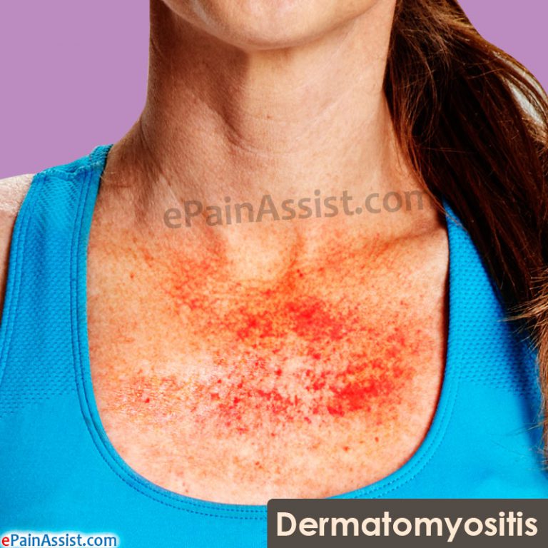 Dermatomyositis: Types, Epidemiology, Causes, Signs, Symptoms, Treatment, Investigations