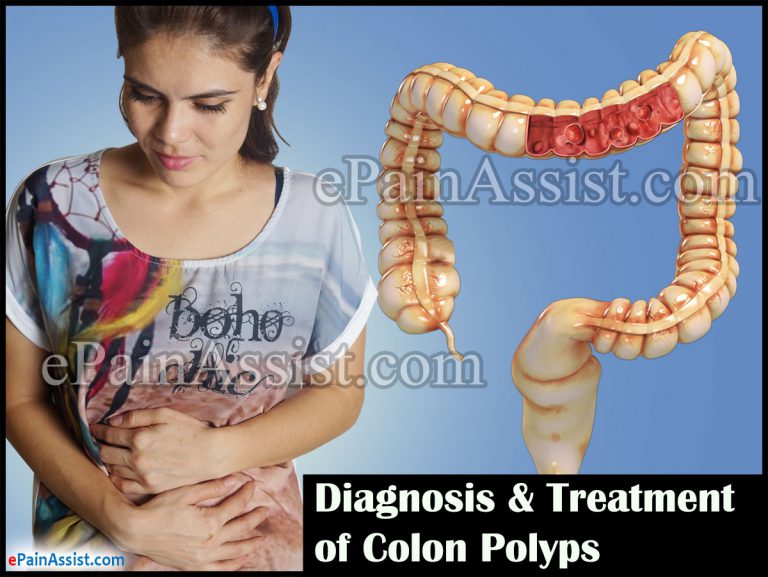 Diagnosis & Treatment of Colon Polyps