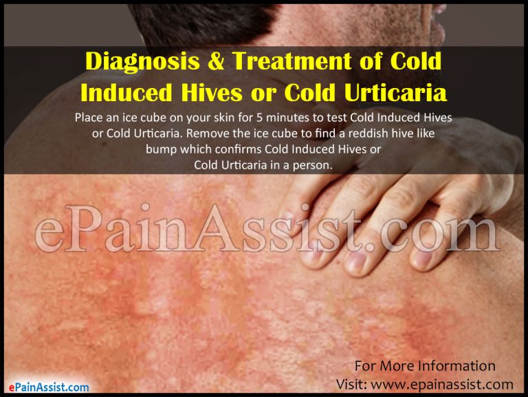 Diagnosis & Treatment of Cold Induced Hives or Cold Urticaria