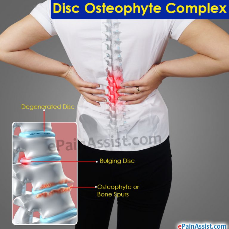 Disc Osteophyte Complex: Causes, Symptoms, Treatment