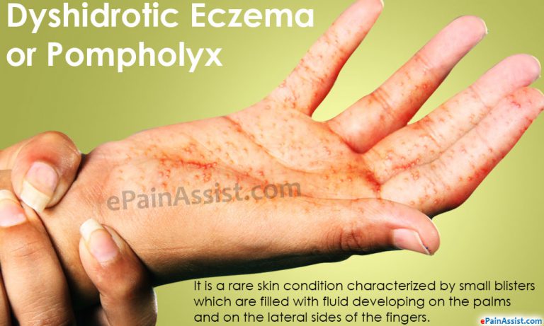Dyshidrotic Eczema or Pompholyx: Causes, Risk Factors, Signs, Symptoms, Investigations, Treatment, Home Remedies, Prevention