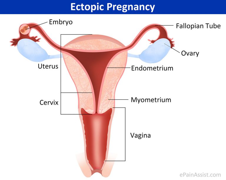 Ectopic Pregnancy or Eccyesis: Types, Causes, Signs, Symptoms, Investigations, Treatment