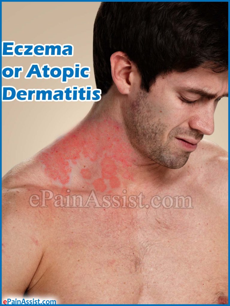 Eczema or Atopic Dermatitis: Causes, Symptoms, Treatment, Home Remedies, Prevention