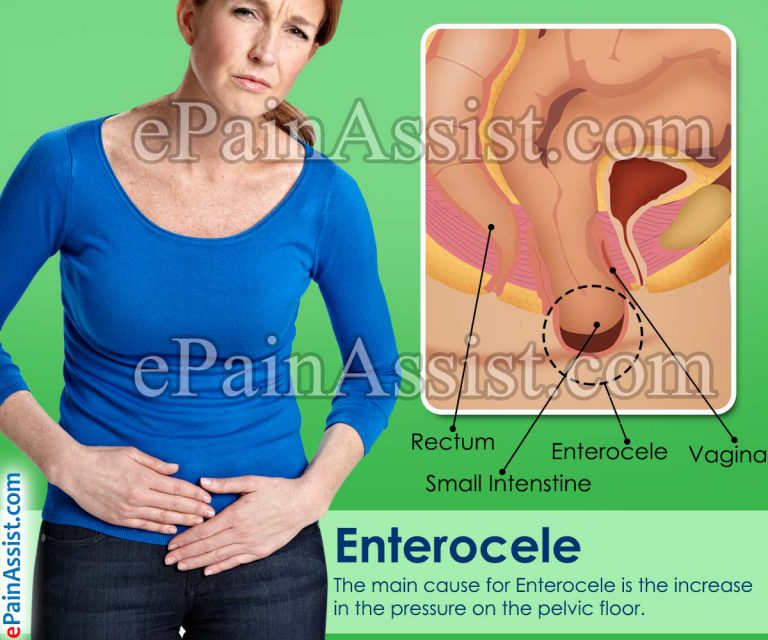 Enterocele: Causes, Symptoms, Diagnosis, Treatment, Home Remedies, Prevention