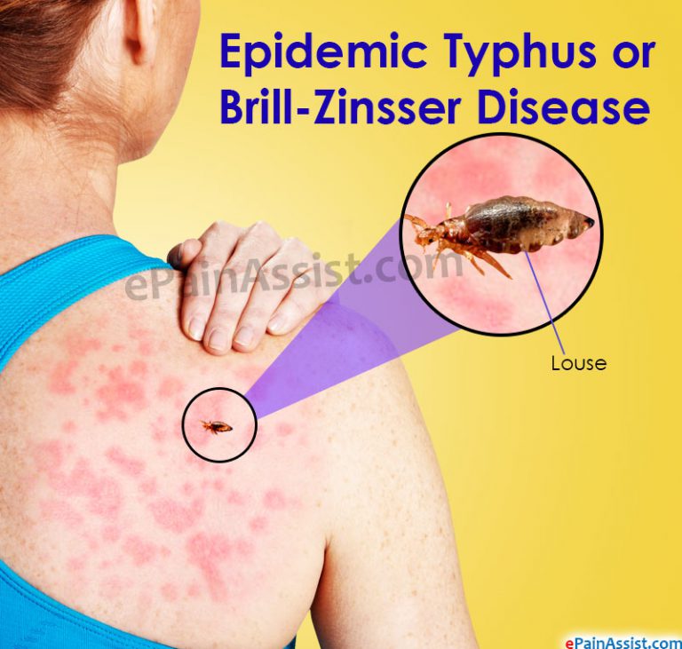 How is Epidemic Typhus or Brill-Zinsser Disease Transmitted and How Can it be Treated?