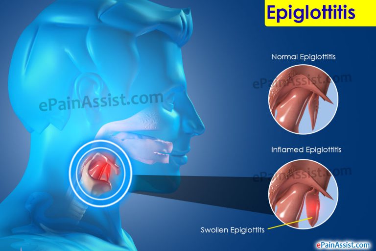 Epiglottitis : Causes, Symptoms, Treatment, Prevention