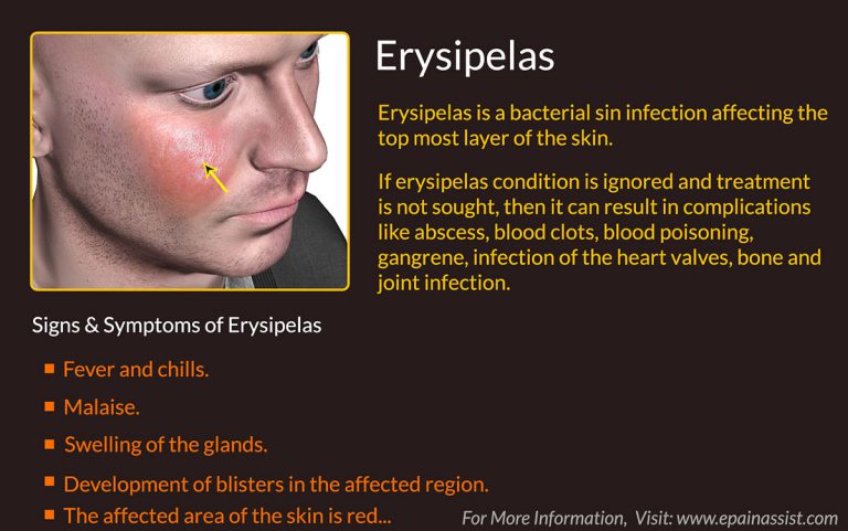 Erysipelas: Causes, Risk Factors, Signs, Symptoms, Treatment, Prevention, Prognosis