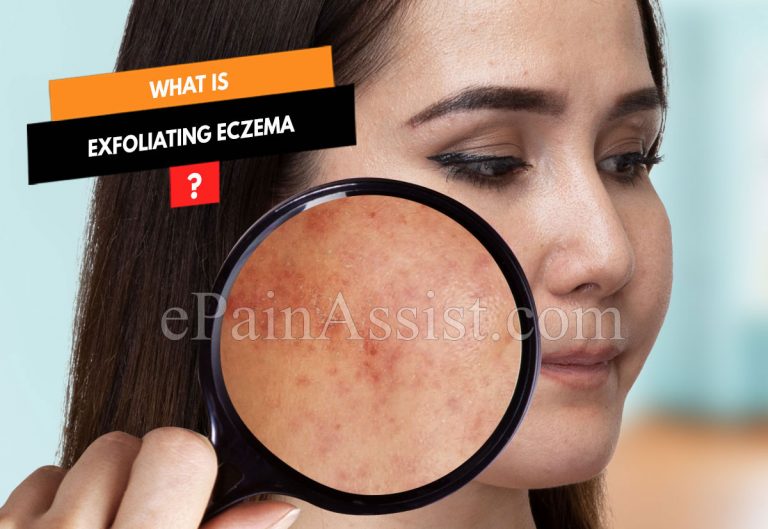Exfoliating Eczema