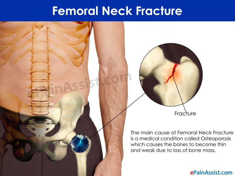 What is Femoral Neck Fracture?