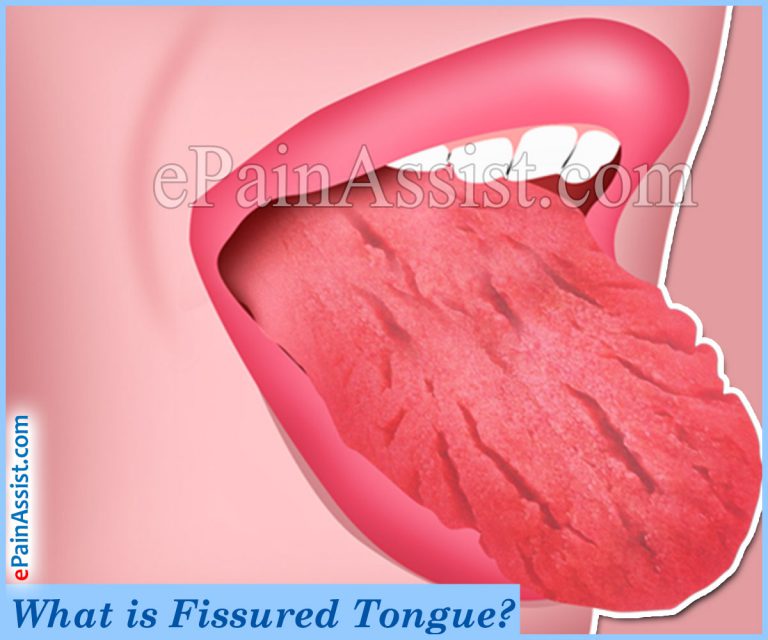 What is Fissured Tongue?