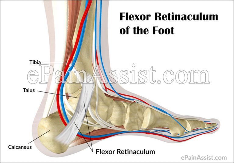 Strained Flexor Retinaculum of the Foot