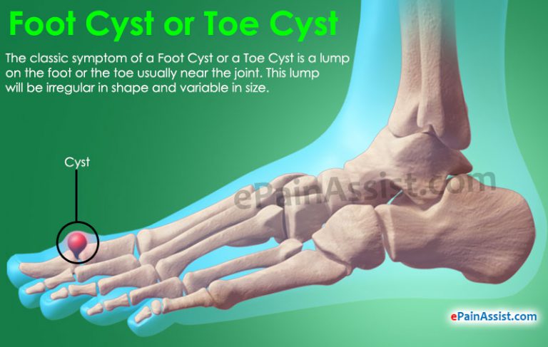 Foot Cyst or Toe Cyst – Causes, Symptoms, Treatment