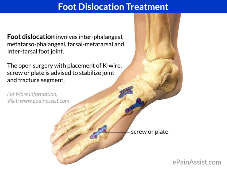 Foot Dislocation Treatment: ER, Elective, Surgical Treatment- Closed Reduction & Open Reduction, Post Surgical Treatment