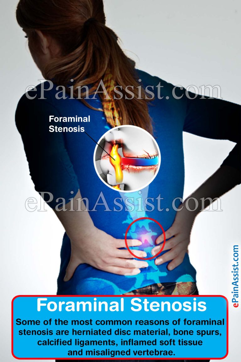 Foraminal Stenosis: Types, Causes, Symptoms, Treatment