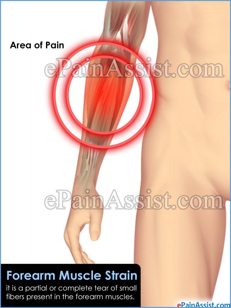 Forearm Muscle Strain: Causes, Symptoms, Treatment, Recovery, Exercises