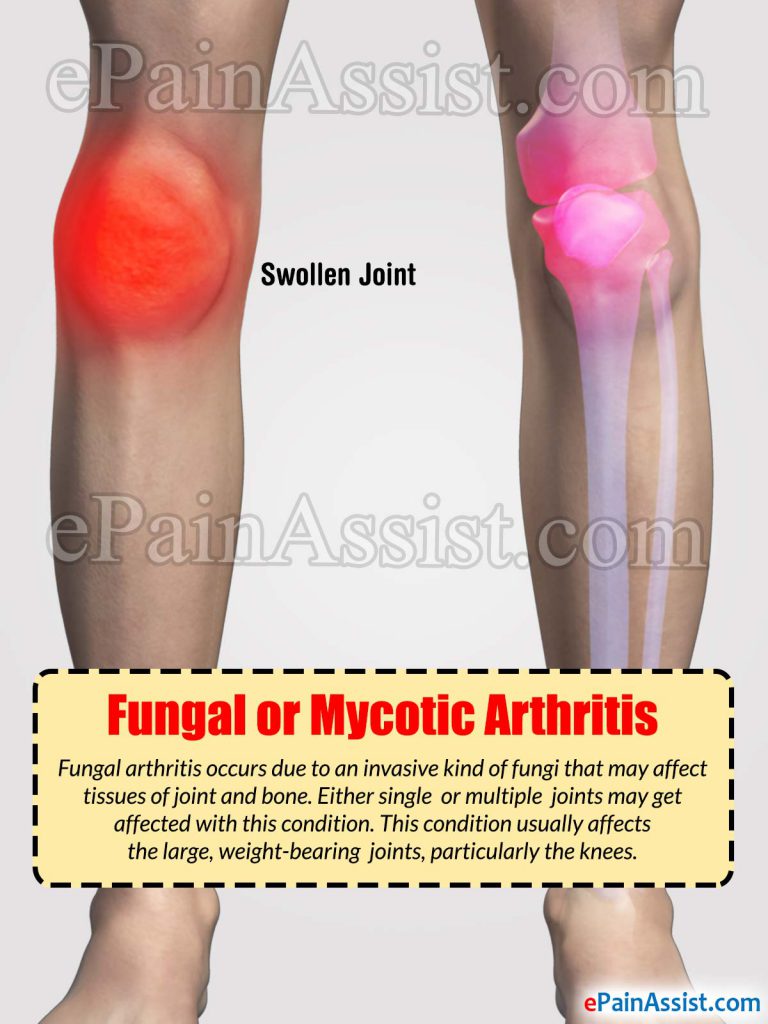 Fungal or Mycotic Arthritis: Causes, Symptoms, Treatment- Antifungal, Investigations