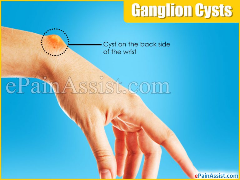 Ganglion Cysts: Symptoms, Causes, Treatment, Recurrence, Body Parts Affected