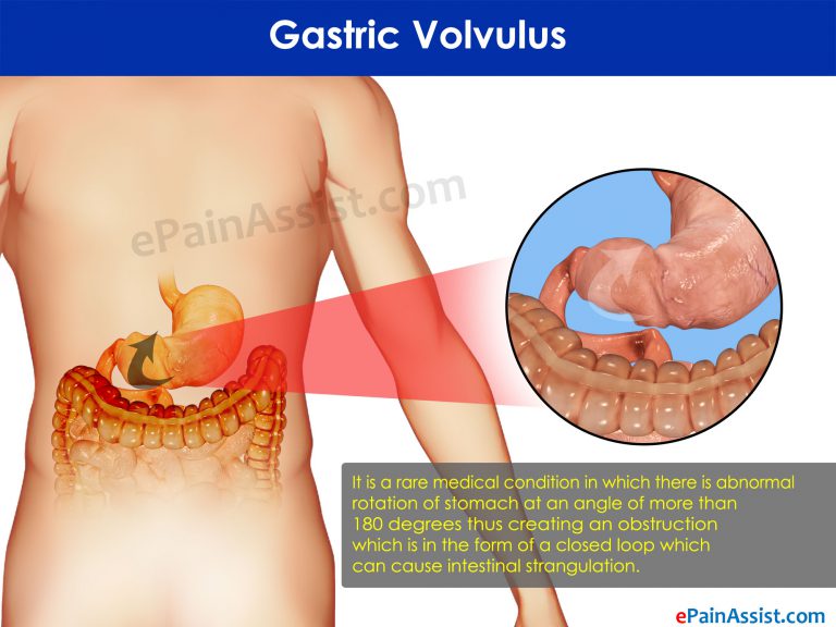 Gastric Volvulus: Treatment & Diet For Volvulus of Stomach