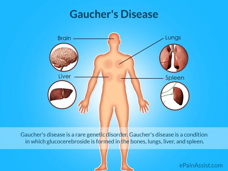 Gaucher’s Disease or Glucosylceramidase Deficiency : Types, Causes, Signs, Symptoms, Treatment