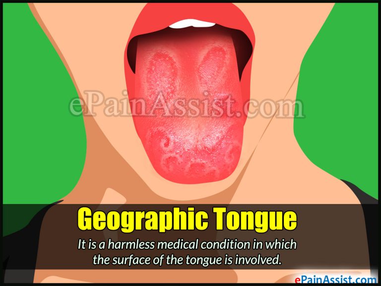 Geographic Tongue: Causes, Symptoms, Signs, Treatment