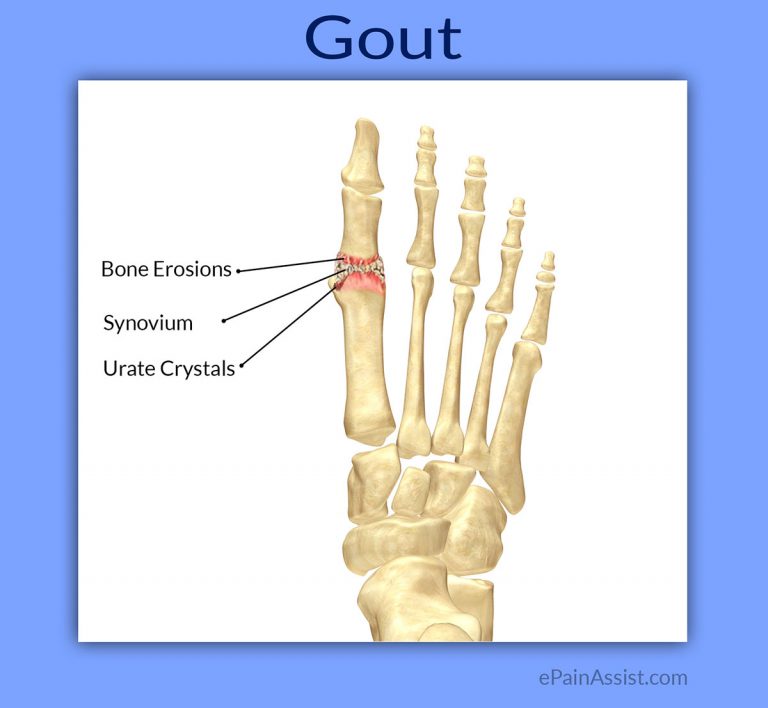 Gout: Causes, Risk Factors, Symptoms, Diagnosis, Treatment, Prevention