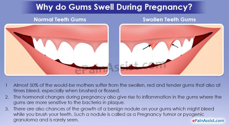Why Do Gums Swell During Pregnancy And How To Treat Them?