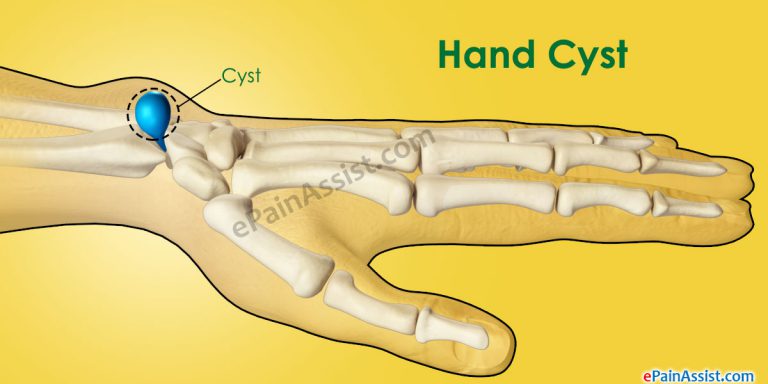 Hand Cyst – Causes, Symptoms, Treatment