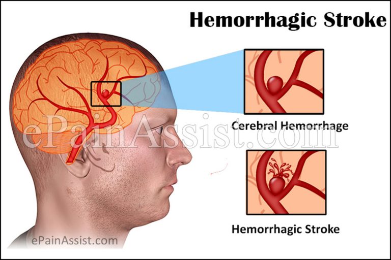 Hemorrhagic Stroke: Symptoms, Treatment, Recovery, Survival, Causes, Types, Prognosis