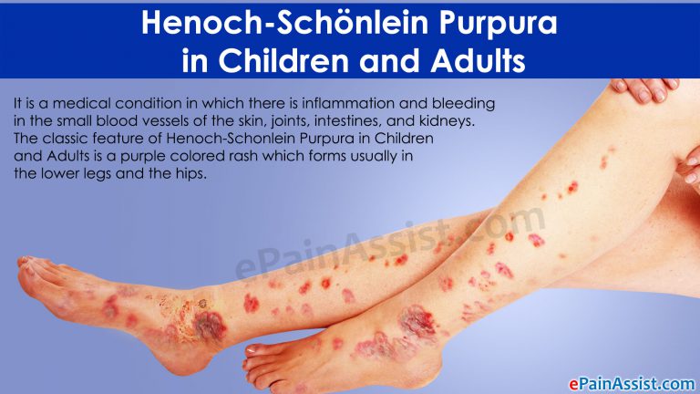 Henoch-Schönlein Purpura in Children and Adults