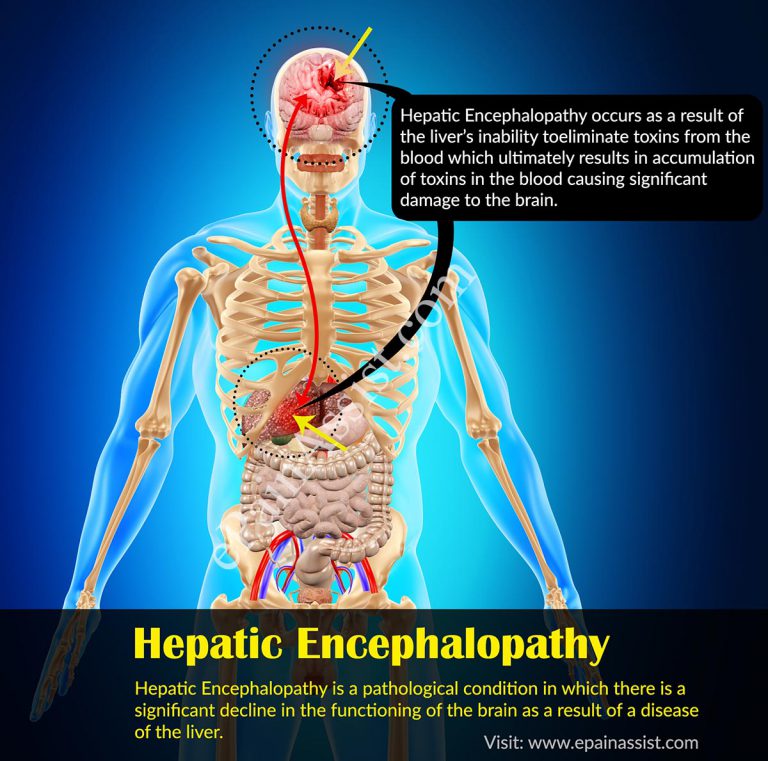 Hepatic Encephalopathy: Causes, Symptoms, Treatment, Prognosis, Prevention, Diagnosis