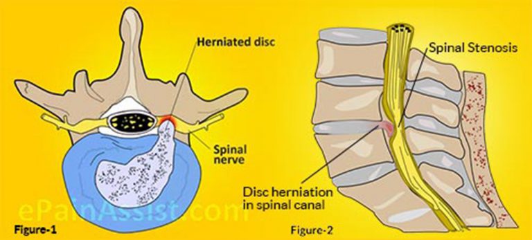 Lumbar Disc Herniation: Causes, Symptoms, Treatment-Manual Therapy, PT, Surgery