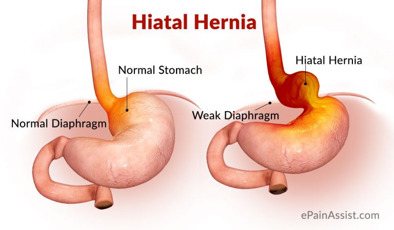 Hiatal Hernia or Hiatus Hernia: Causes, Risk Factors, Signs, Symptoms, Tests, Treatment