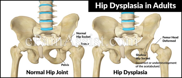 What Causes Adult Hip Dysplasia and How is it Treated?