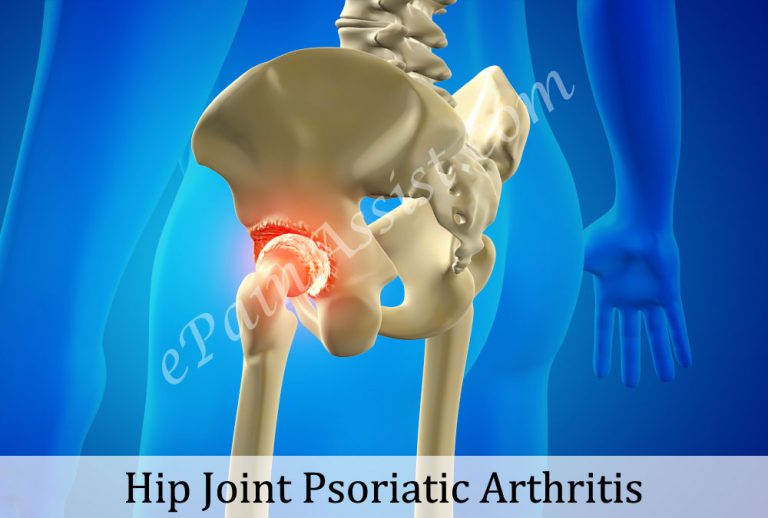 Hip Joint Psoriatic Arthritis: Causes, Symptoms, Treatment, PT, Surgery