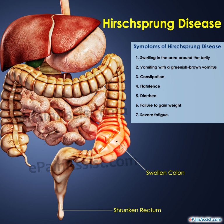 Hirschsprung Disease: Symptoms, Treatment, Childs Quality of Life, Complications, Home Remedies