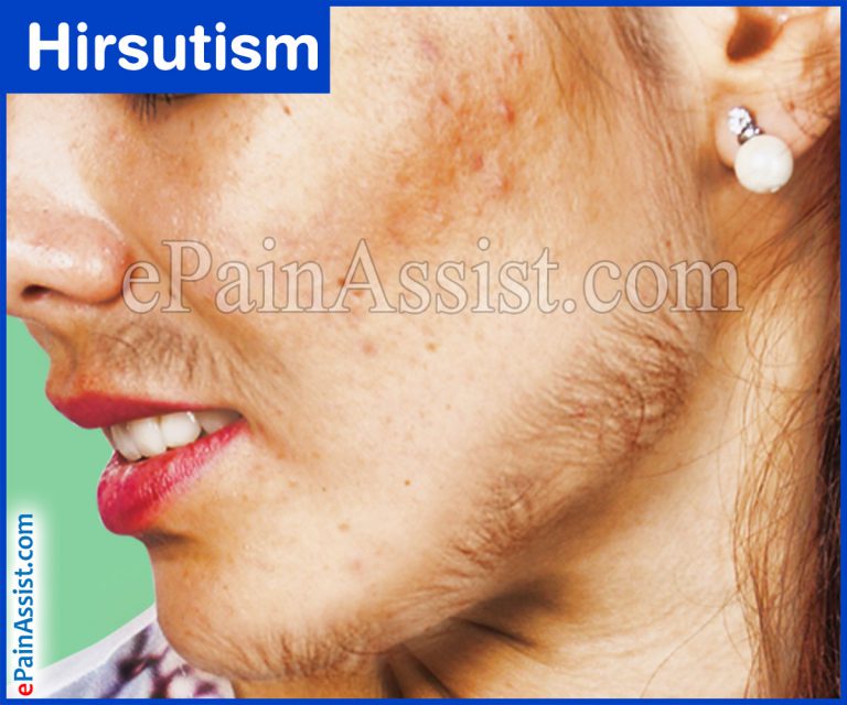 Hirsutism: Causes, Risk Factors, Symptoms, Investigations, Treatment, Home Remedies
