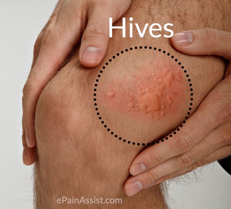 Hives & Angioedema: Causes, Symptoms, Treatment, Home Remedies, Prevention