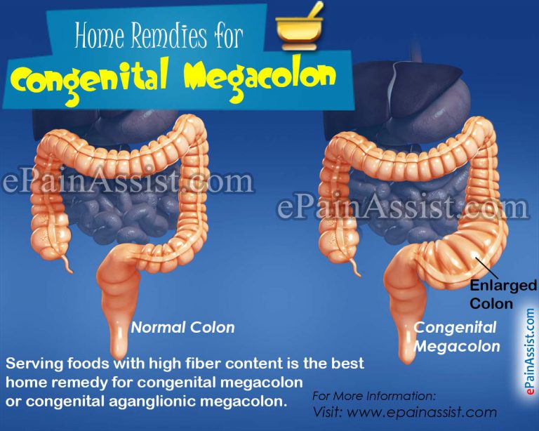 Home Remedies & Recovery Period of Congenital Megacolon or Congenital Aganglionic Megacolon