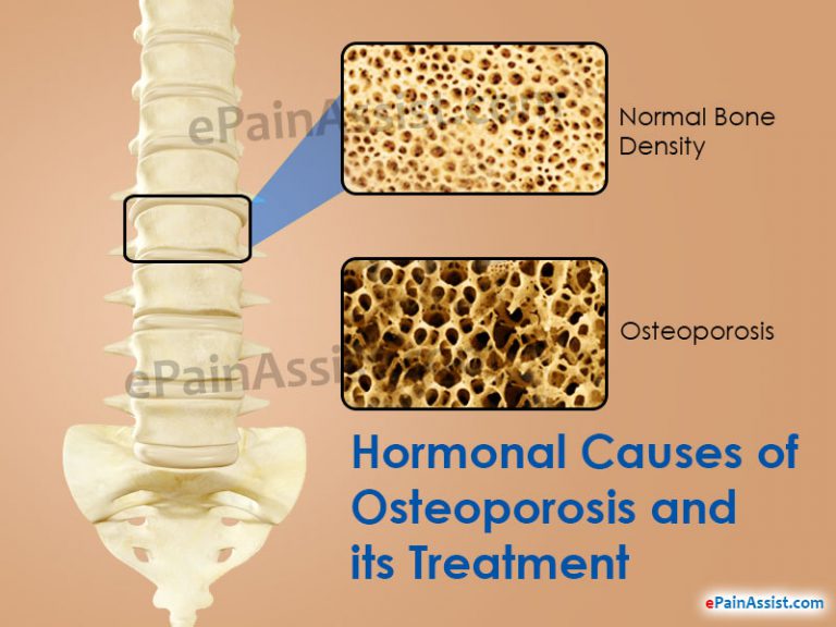 Hormonal Causes of Osteoporosis and Its Treatment