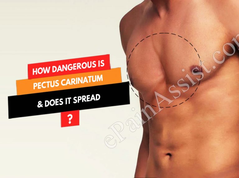 How Dangerous Is Pectus Carinatum & Does It Spread?