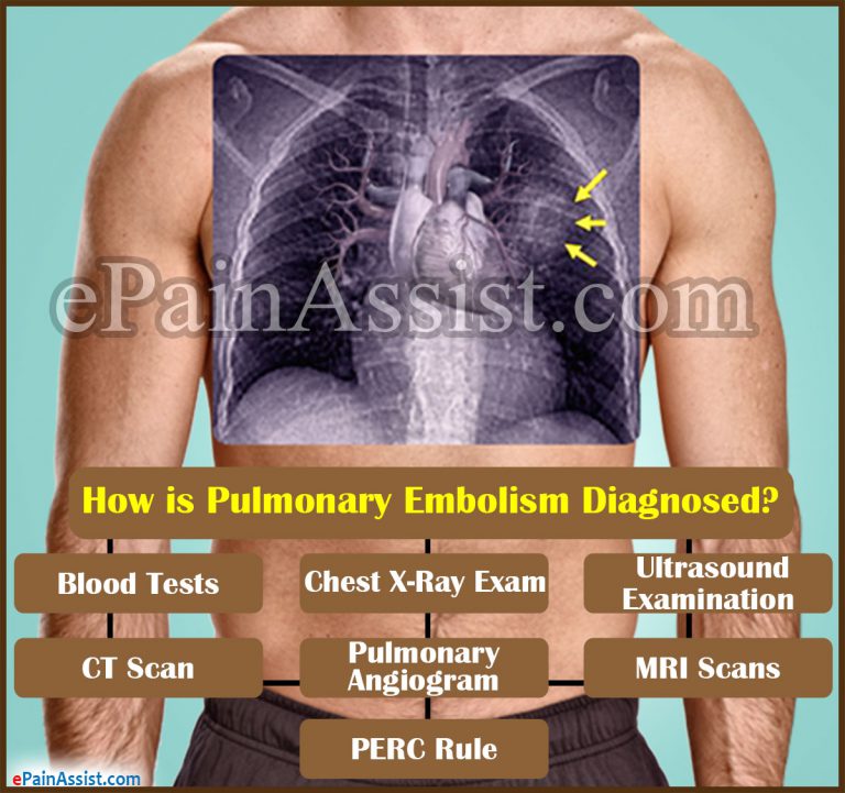 How is Pulmonary Embolism Diagnosed & What are its Complications?