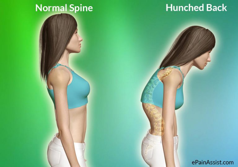 Hunchback: Causes, Symptoms, Signs, Investigations, Treatment, Exercises, Posture Brace