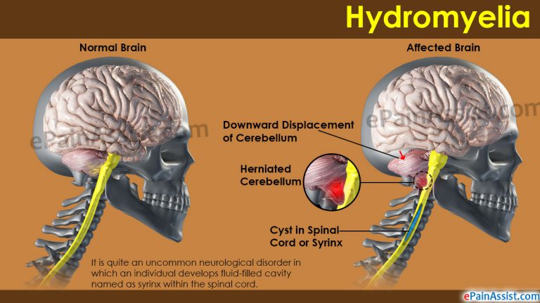 Hydromyelia: Causes, Symptoms, Treatment