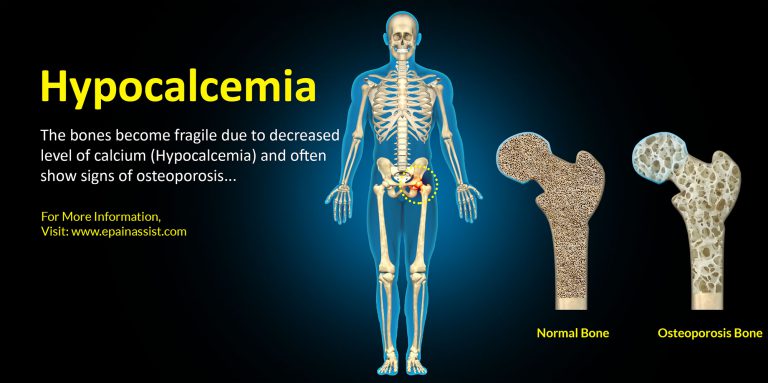 Hypocalcemia: Causes, Symptoms, Treatment, Diagnosis, Complications