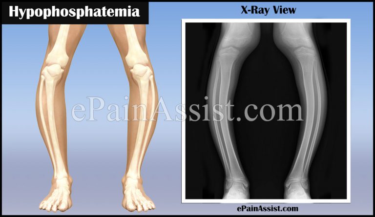 Hypophosphatemia: Causes, Symptoms, Diagnosis, Treatment, Prognosis